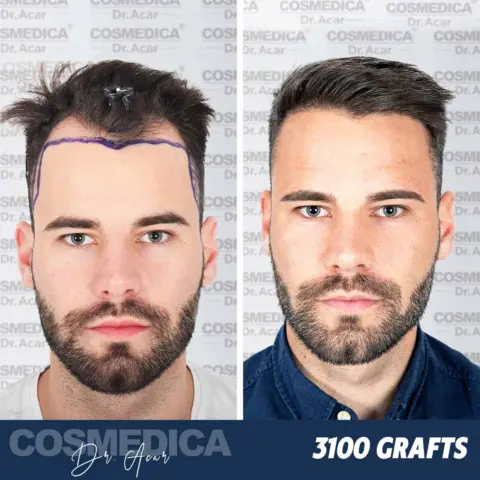 Cosmedica Hair Transplantation Clinic