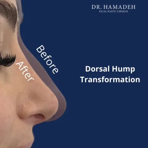 Dr Nizar Hamadeh — Rhinoplasty