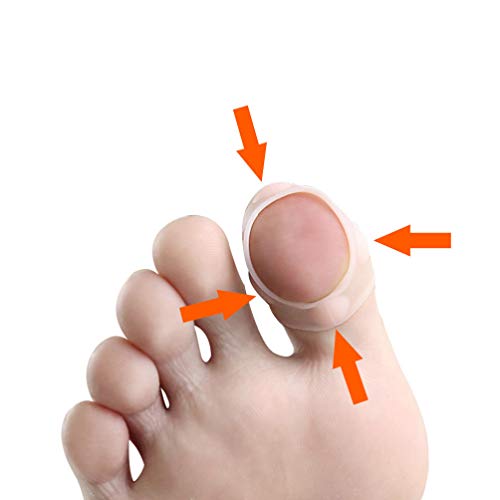 HEALLILY Ingrown Toenail Tool Toenail Corrector Patch Paronychia Toenail Treatment Tape Toenail Correction Sticker Paronychia Recover Foot Care T
