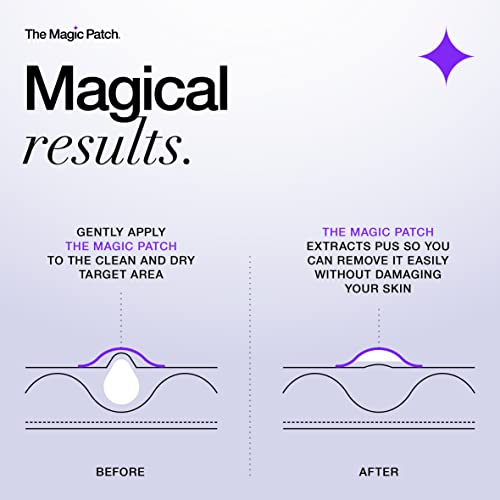 The Magic Patch Acne Patches - Pack of 30 Translucent Hydrocolloid Pimple Patch Spot Treatment Stickers for Face and Body - Fast-Acting, Vegan &