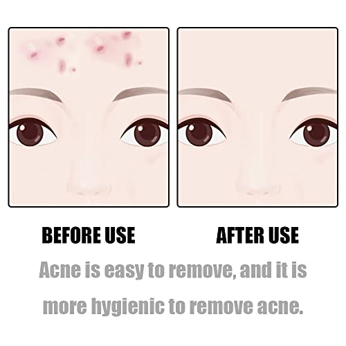 Professional Comedones Extractors Stainless Steel Ingrown Hair Tweezers Blackhead Remover Splinter Sharp Tip Tweezers for Acne