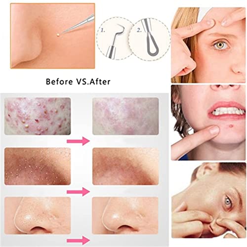 Blackhead Remover Tool, 4Pcs Comedone Extractor Tool Acne Removal Kit Pimple Popper Tool Kit Acne Needles Double Side Spot Squeezer Tool for Pimp