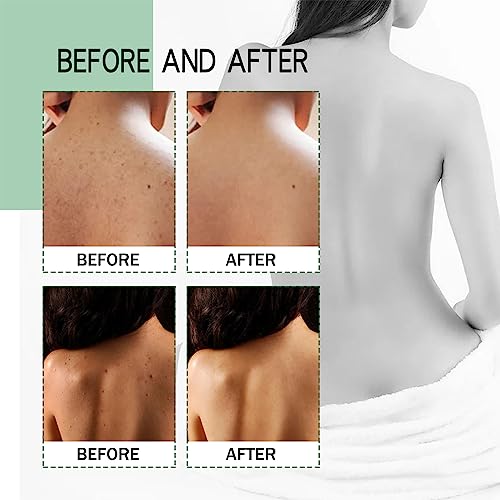 Back Acne Treatment Spray, Lighten Acne Marks Skin Care Spray, Herbaluxy Back Acne, Repair Back Shoulder Acne & Body Acne & Chest Acne & Butt Acn