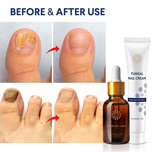 Fungal Nail Treatment, Fungal Nail Treatment for Toenail Extra Strong, Nail Fungus TreatmentforToenail, Toe Nail Fungus Treatment, Toenail Fungus