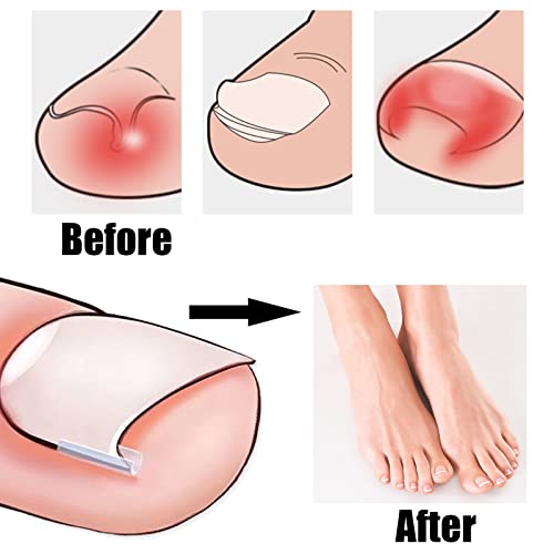 52 Pcs Ingrown Toenail Correction Strips Brace Kit, Ingrown Toenail Corrector Toenail Correction Patches Ingrown Toenail Treatment Toenail Straig