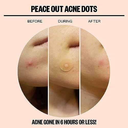 Peace Out Skincare Acne Dots. Hydrocolloid Anti-Acne Pimple Patches with Salicylic Acid to Quickly Clear Blemishes