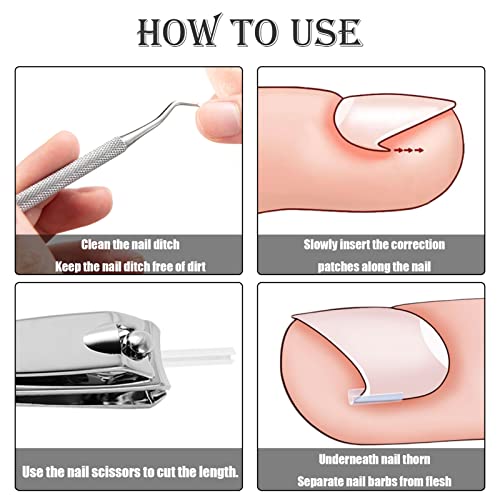 52 Pcs Ingrown Toenail Correction Strips Brace Kit, Ingrown Toenail Corrector Toenail Correction Patches Ingrown Toenail Treatment Toenail Straig