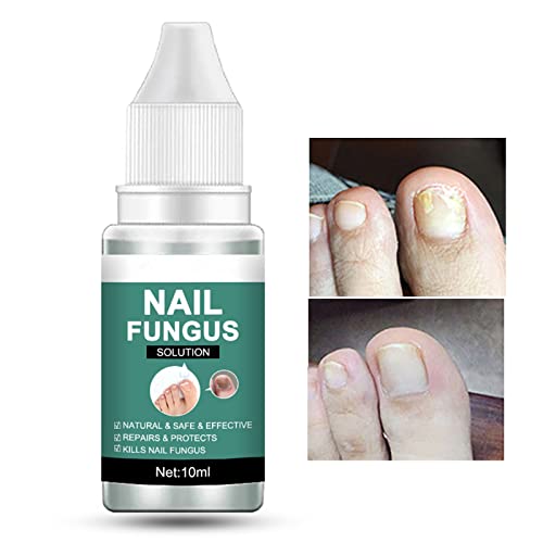 Fungal Nail Treatment for Toenail Extra Strong, Safety Effective Nail Fungus Solution, Ingrown Toenail Treatment Nail Care Oils, Anti Toe Toenail