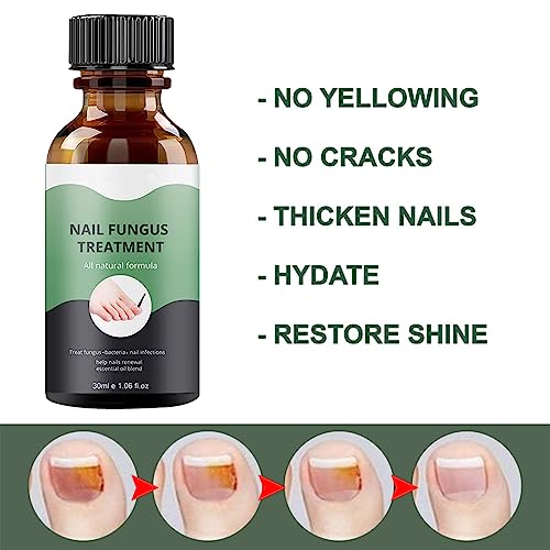 Fungal Nail Treatment, Nail Repair Kit For Broken Natural Nails, Extra Strong Fungal Nail Treatment For Toenails And Fingernail, Ingrown Toenail