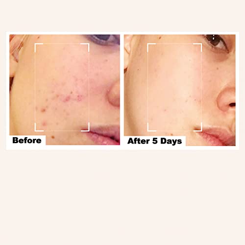 BeBarefaced Acne Treatment Acne Cream Moisturiser - Spot Cream Spot Treatment for Face with Tea Tree Oil and Salicylic Acid BHA - Anti Blemish Fa