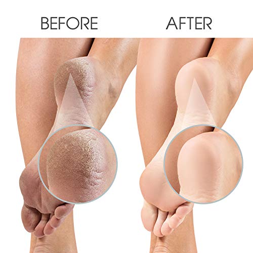 PediCura Professional Foot Files for Hard Skin – The Original Feet Hard Skin Remover Foot Scrub for Super Soft and Smooth Feet - Pedicure Sets fo