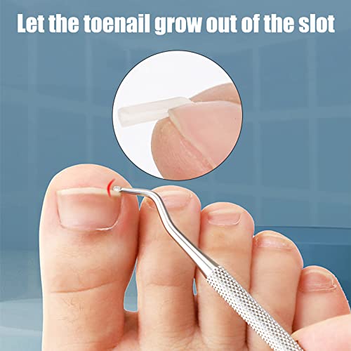 52 Pcs Ingrown Toenail Correction Strips Brace Kit, Ingrown Toenail Corrector Toenail Correction Patches Ingrown Toenail Treatment Toenail Straig