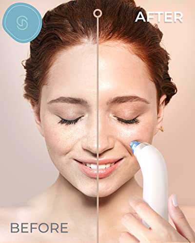 Blackhead Remover Vacuum Pore Cleaner Acne Comedone Extractor Face Blackhead Tool Facial Cleanser Sucker Spot Pimple Whitehead Black Head Deep Su