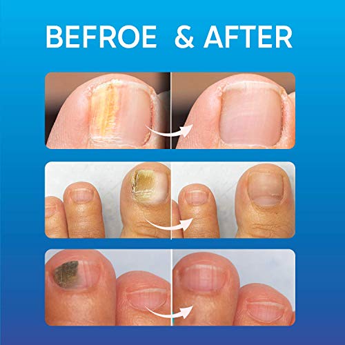 Fungal Nail Treatment, Fungus Nail Cream, Strong Anti-Fungal Toenail Cream, Nail Repair Nourishing Treatment, Restores Discolored and Damaged Nai