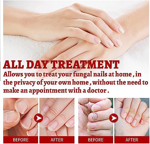 Nail Onychomycosis Rapid Relief Oil,Onychomycosis Rapid Relief Oil,Onychomycosis Nail Treatment Oil,Toenail Repair for Damaged Nails,Collagen Boo