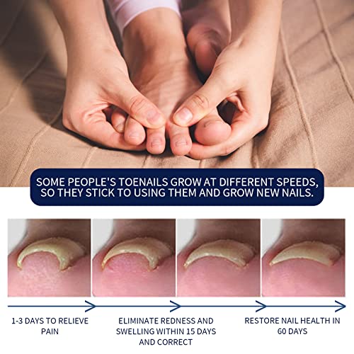 Ingrown Toenail Treatment, Toenailplus Anti Paronychia Relief Oil, Toenailplus Anti Paronychia Relief Oil, Paronychia Treatment Toe and Fingernai