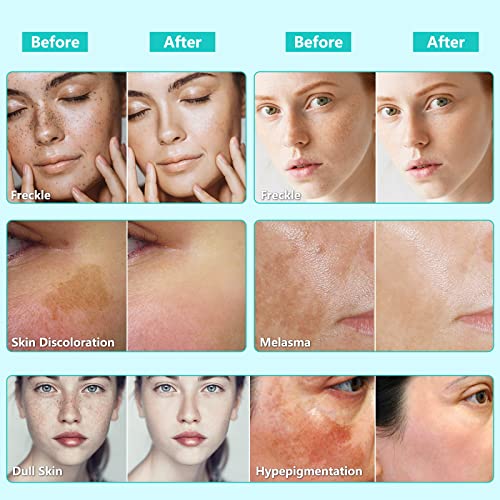 Dark Spot Remover for Face Dark Spot Corrector and Remover for use on face, body, or sensitive intimate areas, treat dark spots, age spots, or su