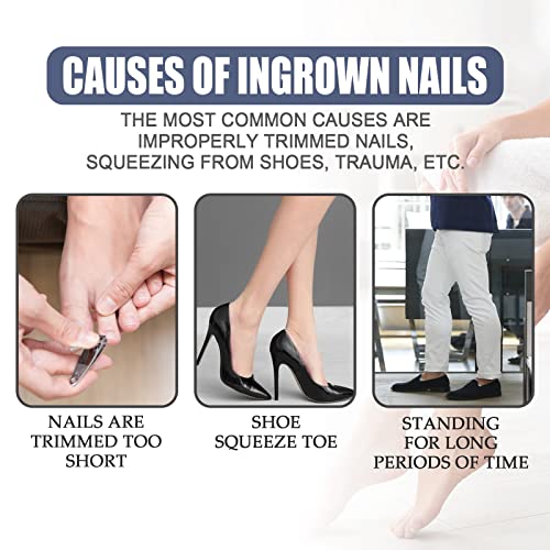 Ingrown Toenail Treatment, Toenailplus Anti Paronychia Relief Oil, Toenailplus Anti Paronychia Relief Oil, Paronychia Treatment Toe and Fingernai