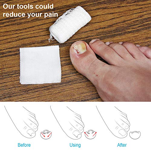2 Pieces Ingrown Toenail Lifter Ingrown Toenail Tool Toe Clamp Stainless Steel Foot Care Tool for Paronychia (Gold)