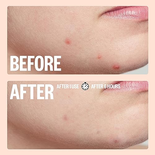 Peace Out Skincare Acne Dots. Hydrocolloid Anti-Acne Pimple Patches with Salicylic Acid to Quickly Clear Blemishes