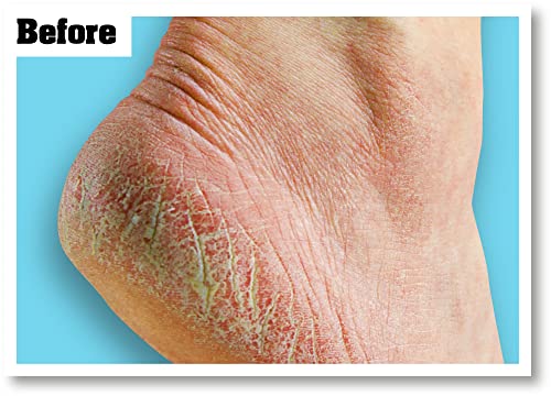 O'Keeffe's Healthy Feet, 80ml – Foot Cream for Extremely Dry, Cracked Feet | Instantly Boosts Moisture Levels, Creates a Protective Layer & Preve