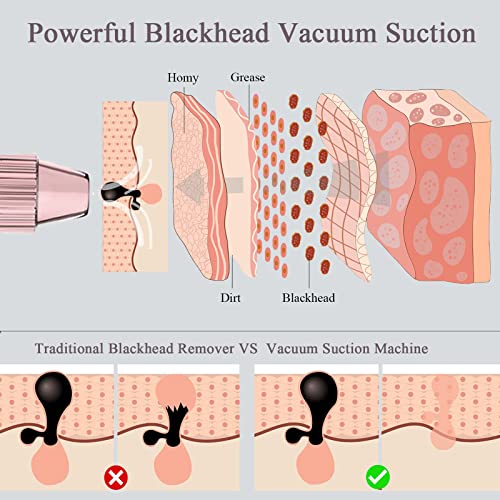 Blackhead Remover Vacuum Blackhead Remover Blackhead Extractor Pore Cleaner Black Head Remover Face Vacuum Pore Extractor - Includes Blackhead Re