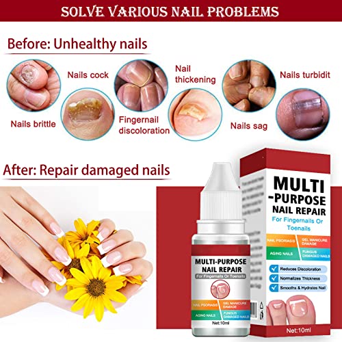 Fungal Nail Treatment for Toenail Extra Strong, Multi-purpose Nail Repair for Fingernails Toenails, Toe Nail Fungal Treatment Fungal Nail Solutio