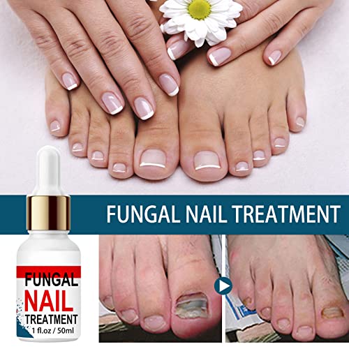 Fungal Nail Treatment for Toenails Extra Strong, Toenail Fungus Treatment Nail Repair for Fingernails Toenails, Toe Nail Fungal Treatment Fungal