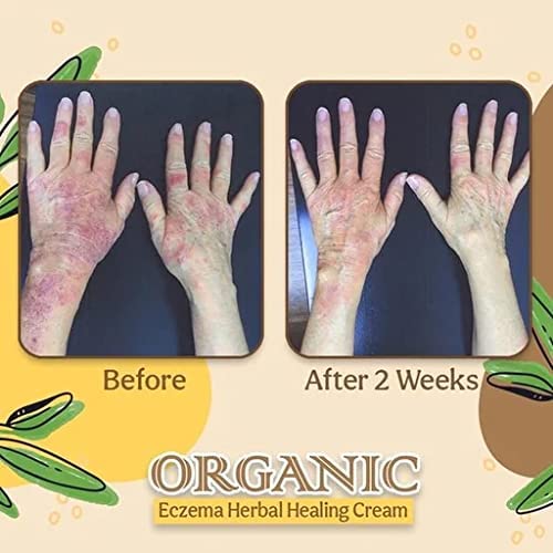Organic Eczema Herbal Healing Cream, Natural Chinese Herbal Cream, Face Cream, Body Cream, Psoriasis Ointment Cream (3)