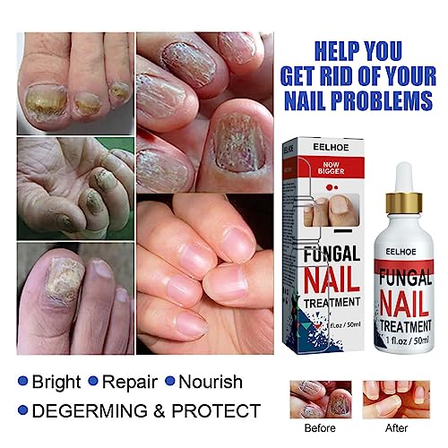 Fungal Nail Treatment for Toenails Extra Strong,50ML Nail Fungus Treatment for Toenail,Ingrown Toenail Fungus Treatment,Anti Severe Fungal Nail T