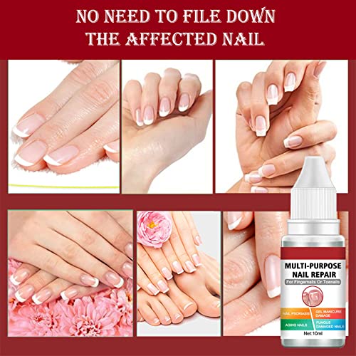Fungal Nail Treatment for Toenail Extra Strong, Multi-purpose Nail Repair for Fingernails Toenails, Toe Nail Fungal Treatment Fungal Nail Solutio