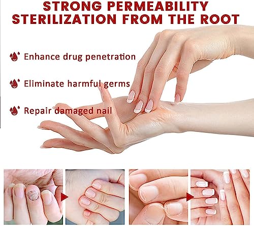 Nail Onychomycosis Rapid Relief Oil,Onychomycosis Rapid Relief Oil,Onychomycosis Nail Treatment Oil,Toenail Repair for Damaged Nails,Collagen Boo