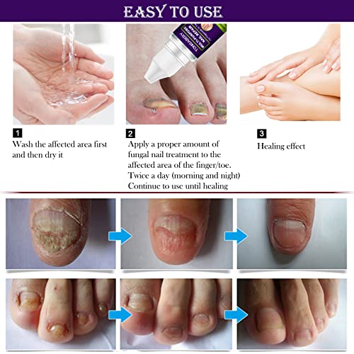 Nail Fungus Treatment, Fungal nail treatment for Toenail Extra Strong, Multi-Purpose Nail Repair for Fingernails Toenails, Nail Fungal Treatment