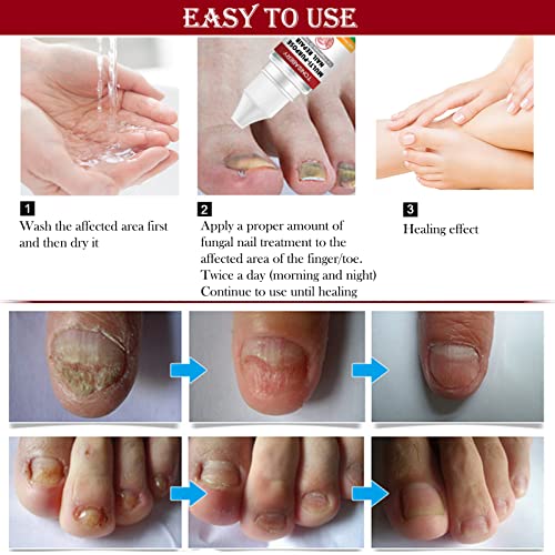 Fungal Nail Treatment for Toenail Extra Strong, Multi-purpose Nail Repair for Fingernails Toenails, Toe Nail Fungal Treatment Fungal Nail Solutio