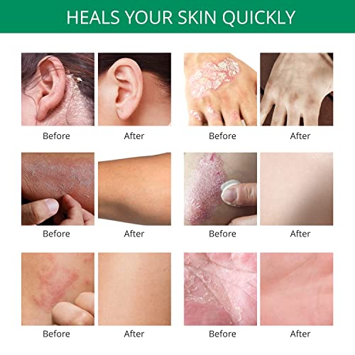 Nupharmisto Psoriasis Cream, Eczema Dermatitis Maximum Strength Relieve Symptom of Resistant, Effective for Seborrheic Dermatitis, Folliculitis,