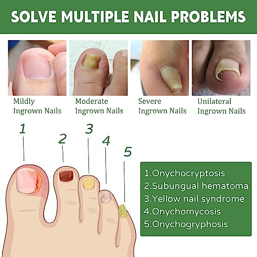 Fungal Nail Treatment, Nail Repair Kit For Broken Natural Nails, Extra Strong Fungal Nail Treatment For Toenails And Fingernail, Ingrown Toenail