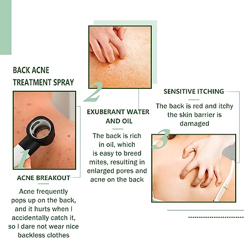 Back Acne Treatment Spray, Lighten Acne Marks Skin Care Spray, Herbaluxy Back Acne, Repair Back Shoulder Acne & Body Acne & Chest Acne & Butt Acn