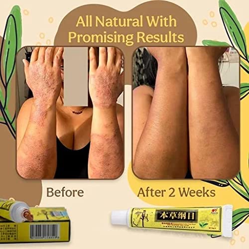 Organic Eczema Herbal Healing Cream, Natural Chinese Herbal Cream, Face Cream, Body Cream, Psoriasis Ointment Cream (3)