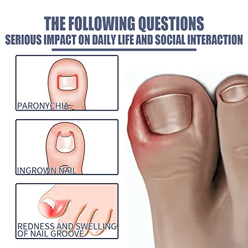 Ingrown Toenail Treatment, Toenailplus Anti Paronychia Relief Oil, Toenailplus Anti Paronychia Relief Oil, Paronychia Treatment Toe and Fingernai