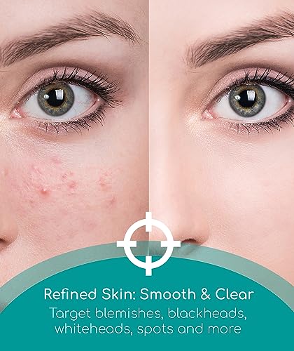 Medi Grade Blackhead Remover Tool with Blotting Paper for Oily Skin, 50-sheets - Comprehensive Pimple Popping Kit for Acne-Prone Skin with Skinca