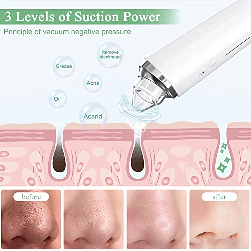 Blackhead Remover Pore Vacuum, Upgraded WIFI Visible Facial Pore Cleanser with HD Camera Pimple Acne Comedone Extractor Kit with 6 Suction Heads