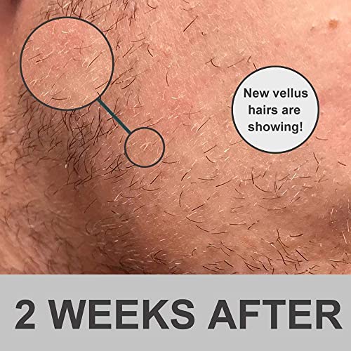 Beard Derma Roller for Beard Growth & Care - Derma Roller for Men - Roller for Home Use - OCHILIMA Beard Growth Roller 0.5mm - Hair Regrowth Micr