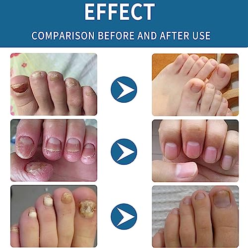 Fungal Nail Treatment for Toenails Extra Strong,50ML Nail Fungus Treatment for Toenail,Ingrown Toenail Fungus Treatment,Anti Severe Fungal Nail T