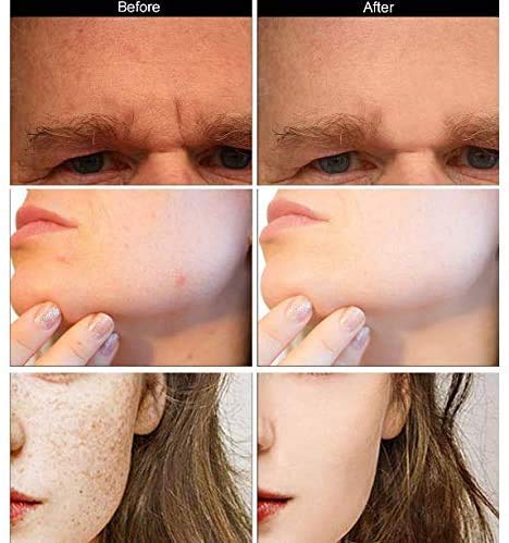 Beard Growth Roller/Derma Roller for Men/Microneedle Roller /540 0.5MM Titanium Needles (0.5mm)