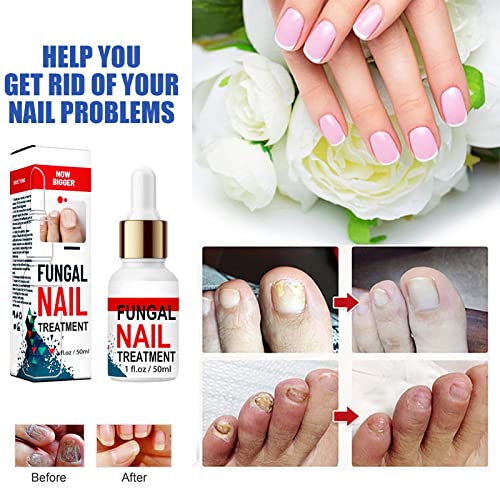 Fungal Nail Treatment for Toenails Extra Strong, Toenail Fungus Treatment Nail Repair for Fingernails Toenails, Toe Nail Fungal Treatment Fungal