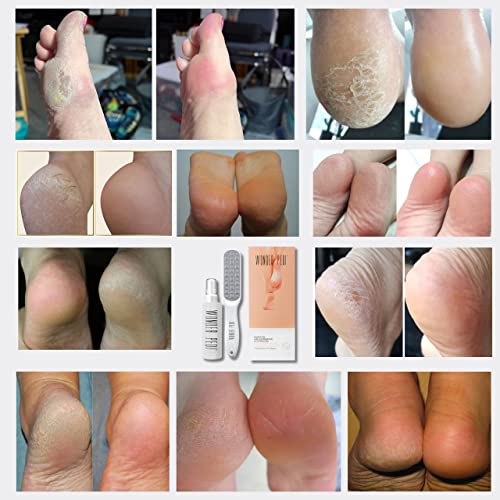 Callus Remover - Three Minutes Quick Fix- Foot File Rasp - Instant Foot Exfoliating Softener Peel Spray, Heels Callus Scrubber File - Home Spa Pe