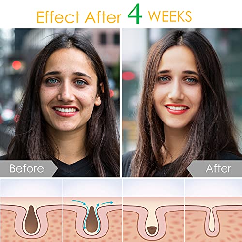 Dark Spot Remover for Face and Body, Age Spot, Sun Spots and Melasma Freckle Remover, Hyperpigmentation Treatment, Liver Spot Corrector, Formulat