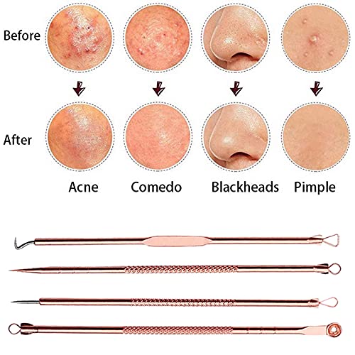 Blackhead Remover Tool Kit,4 Pieces Comedone Extractor Tool Blemish Whitehead Removal Acne Needle Pimple Spot Popper Stainless Steel (Gold)