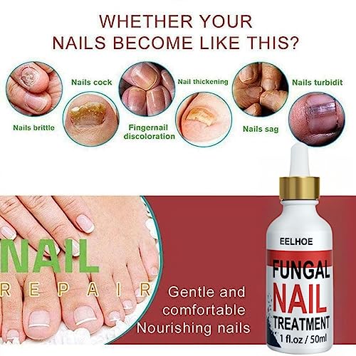 Fungal Nail Treatment for Toenails Extra Strong,50ML Nail Fungus Treatment for Toenail,Ingrown Toenail Fungus Treatment,Anti Severe Fungal Nail T