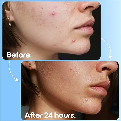 Spot Patches by Patch Perfect® (102 Pimple Patches) - Acne Patch with Absorbing Hydrocolloid Dots for Spot Treatment - Translucent Spot Stickers,